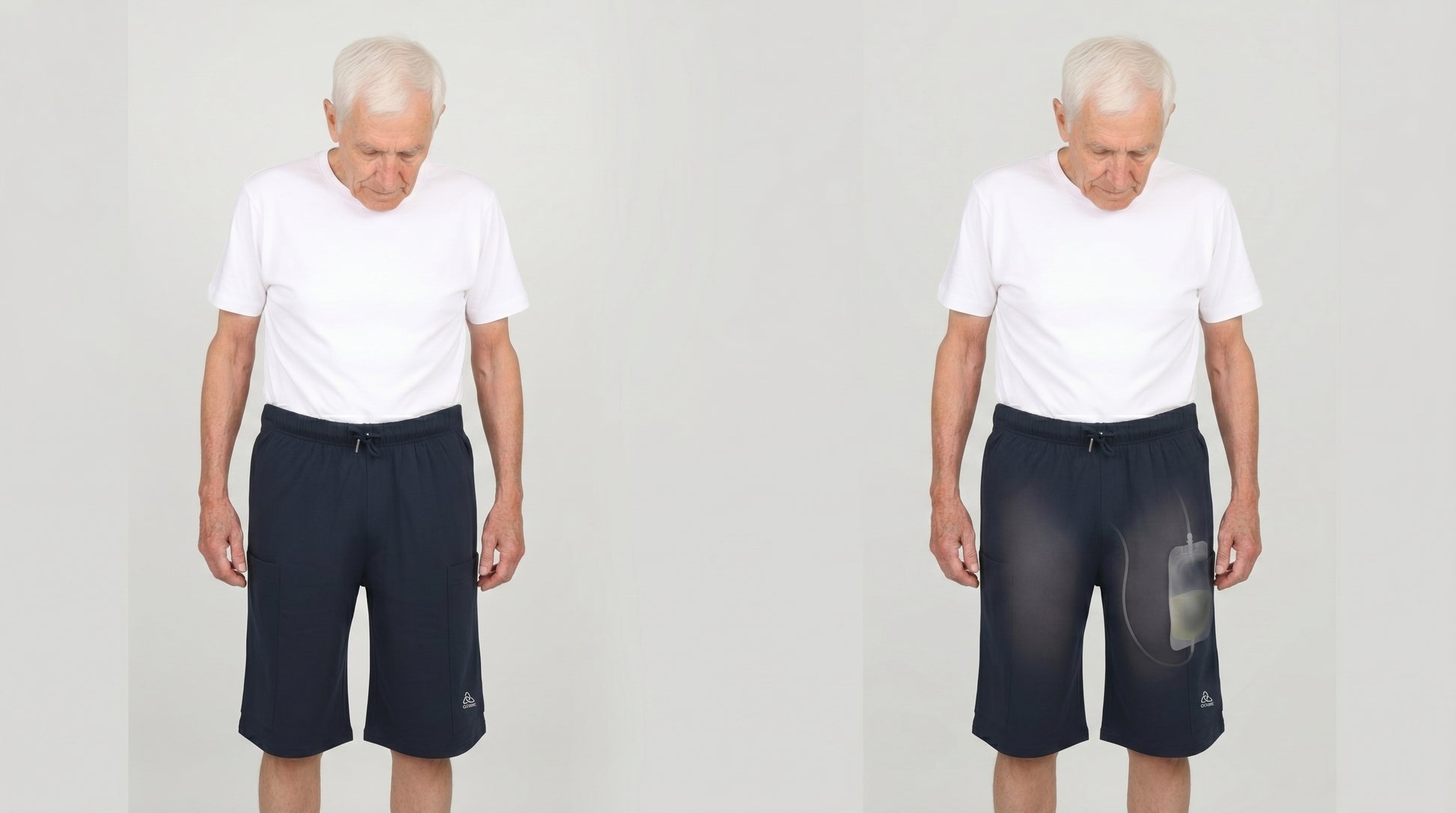 Cure Adaptive Prostate Patient Care and Treatment Shorts