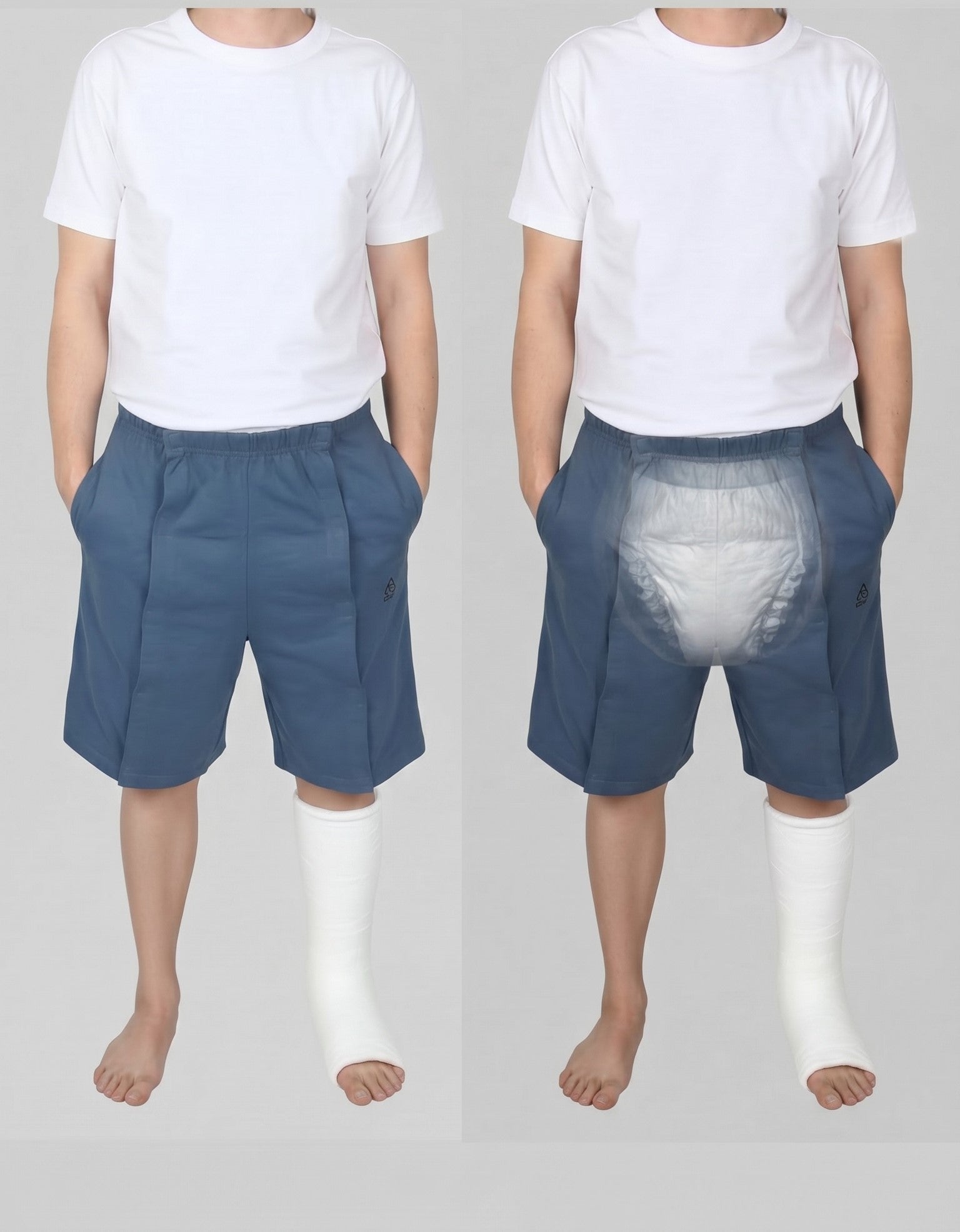 Cure Adaptive Bedridden Patient Care and Treatment Shorts - Velcro Closure
